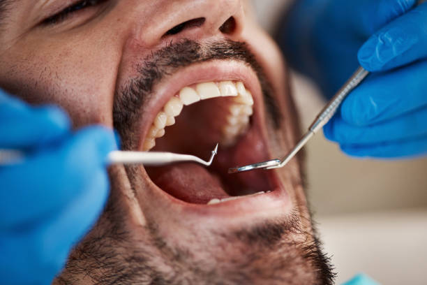 Best Emergency Dentist for Lost Fillings or Crowns in Wade Hampton, SC